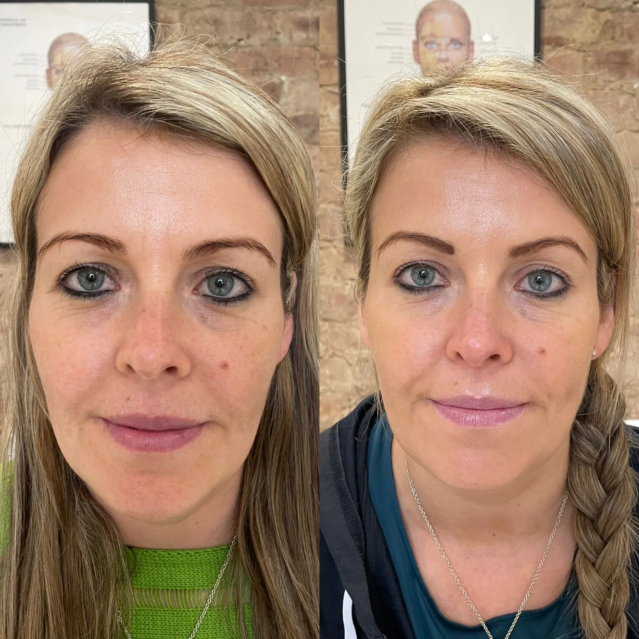Brow lift- antiwrinkle.jpeg