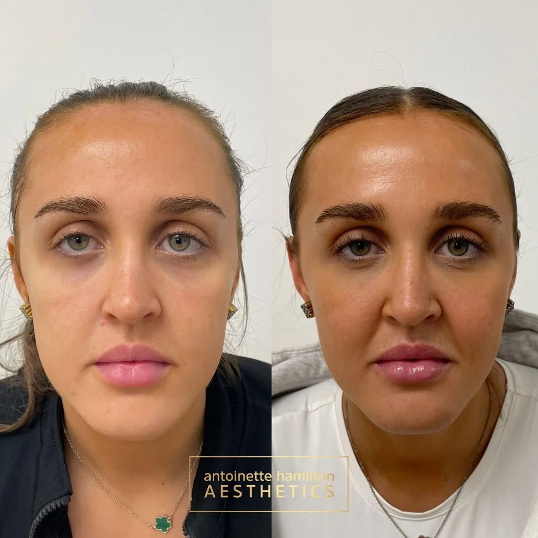 Subtle lift. Strategic support. Soft, refreshed results.

This client received 1ml of cheek filler, placed carefully to restore volume in the midface and provide structural support to the lower eye region &mdash; where early ageing often shows first 