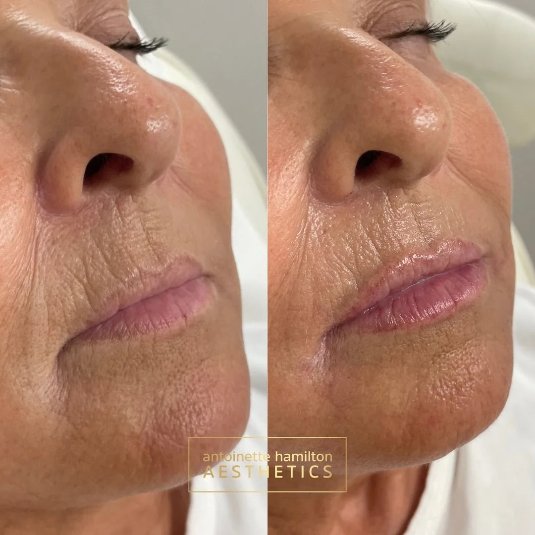 1ml of Belotero Intense for soft, subtle volume and seamless integration 💉

This client wanted hydrated, natural-looking lips with enhanced definition &mdash; and Belotero Intense was the perfect choice.

Why this product? ✔️ Designed for structural
