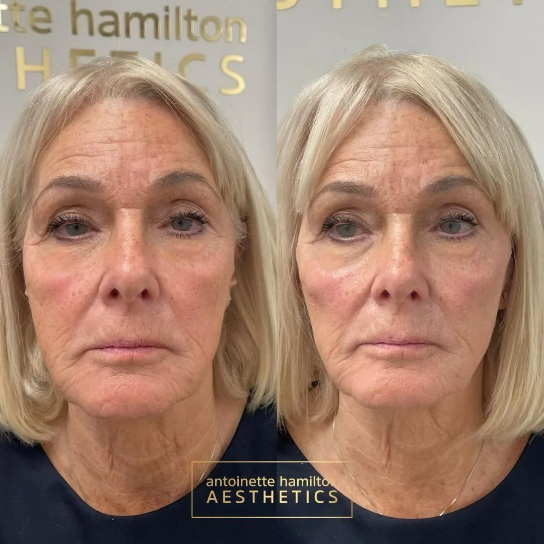 Just 2ml of carefully placed cheek filler has helped lift and restore mid-face volume in a way that flatters this beautiful face, without ever looking overdone.

As we age, we naturally lose structural support from the fat pads and bone in the mid-fa