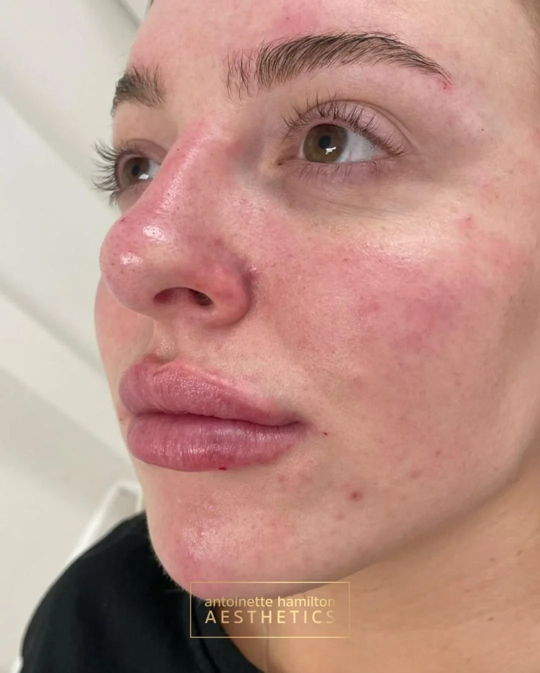 1ml Stylage Special Lips Plus 💉

Fuller lips are crafted slightly differently to a natural style, a different premium filler is also chosen to ensure I meet my patients expectations. For clients who love volume and structure, this premium filler is 