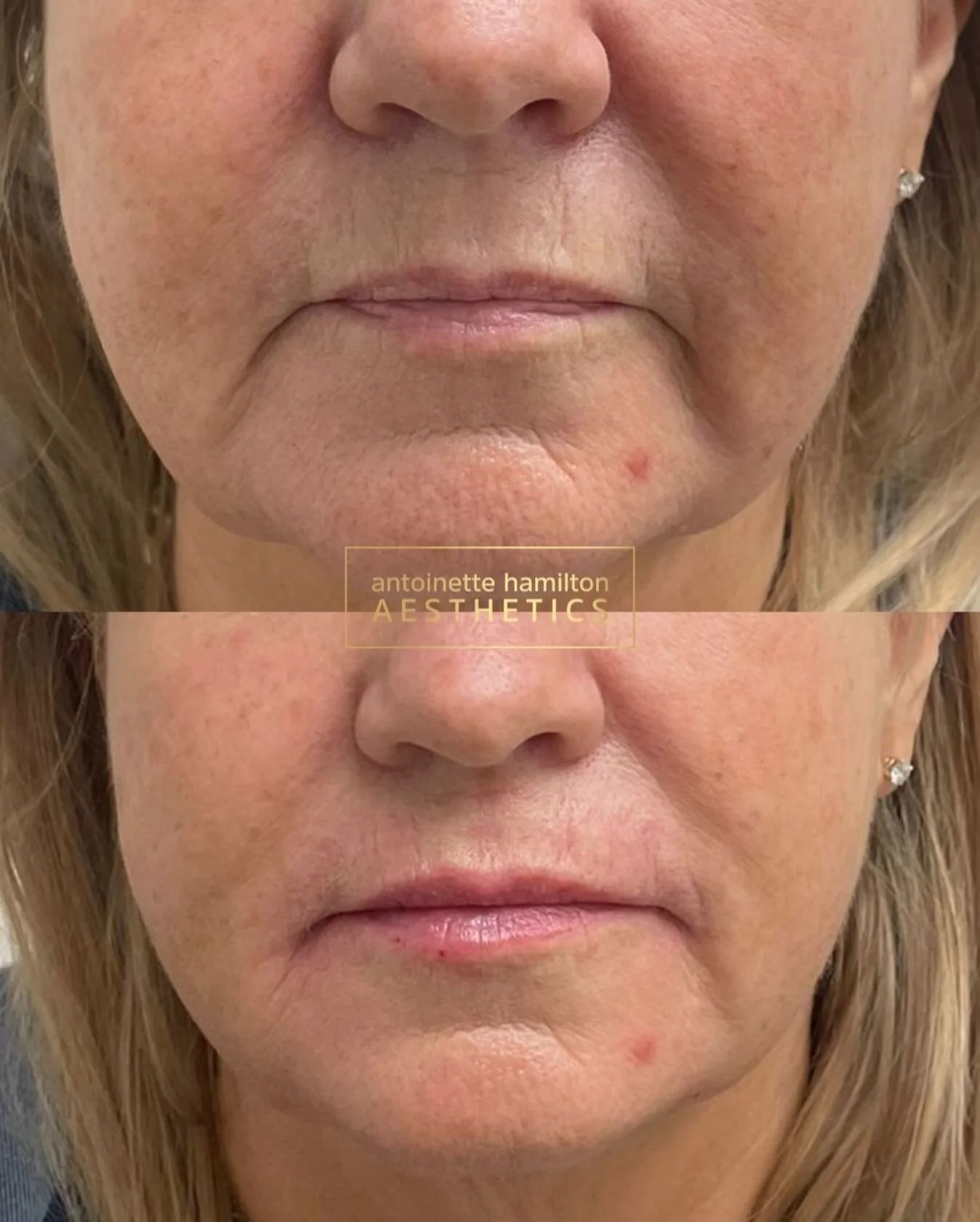 In this treatment, we focused on softening static lines and restoring structure in the lower face &mdash; not changing how you look, but how you feel when you look in the mirror.

1ml to the marionette lines
As we age, volume loss around the chin and