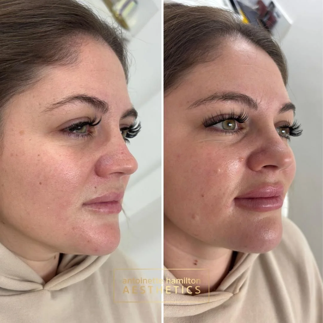 1ml Restylane Kiss 💉

This beautiful transformation was achieved using just 1ml of Restylane Kiss &mdash; a soft, flexible hyaluronic acid filler designed specifically for the lips.

Restylane integrates beautifully with the tissue, giving a smooth,