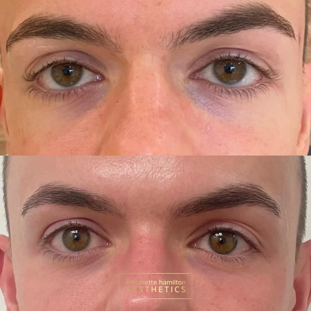 A combined approach to the under-eye area.

For this patient, tear trough filler was paired with polynucleotides to treat both the hollow and the skin itself.

The filler restores gentle support under the eye, while polynucleotides help improve hydra