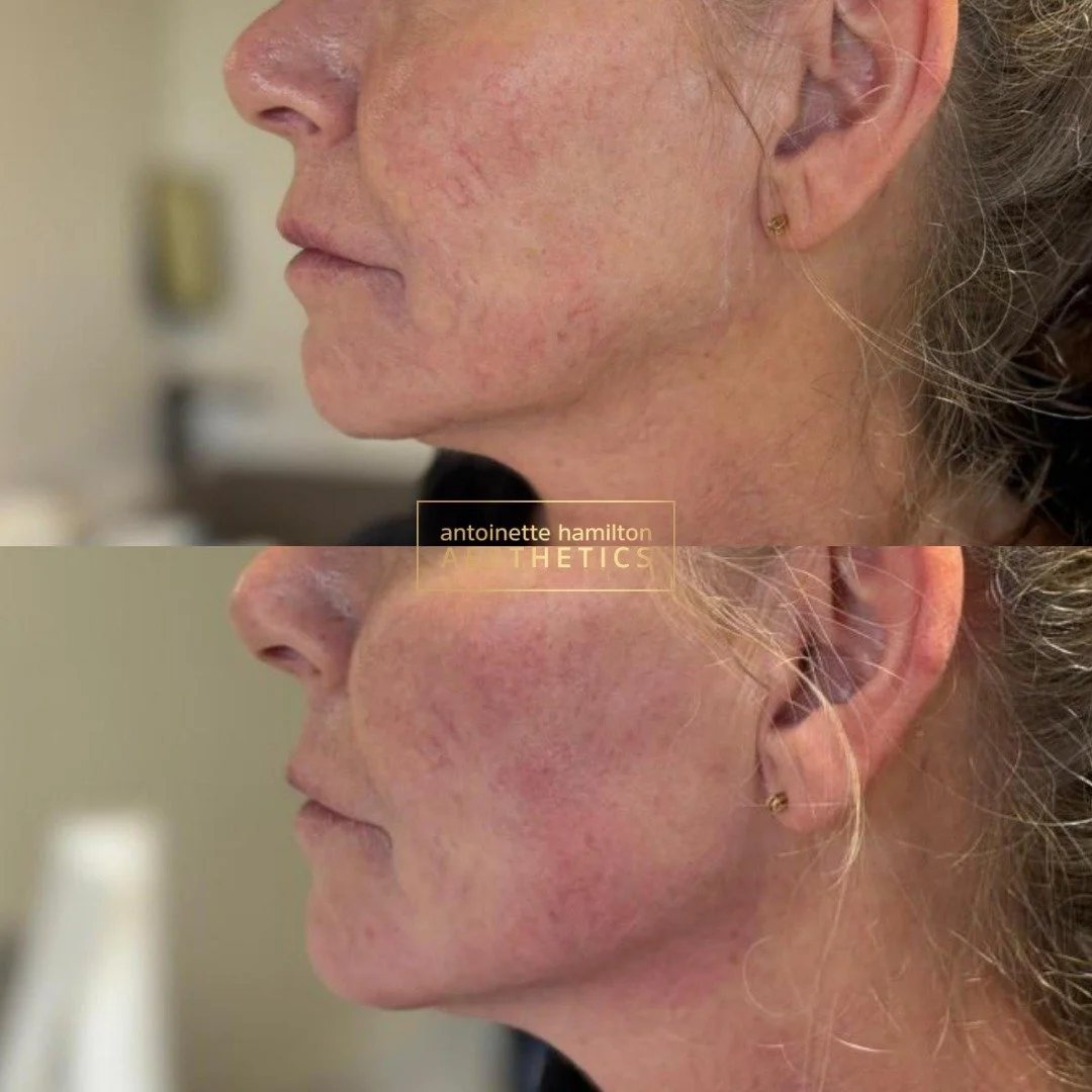 Radiesse works a little differently to traditional fillers. As well as restoring support where it&rsquo;s needed, it also helps stimulate your body&rsquo;s natural collagen over time.

For this patient, 1.5ml of Radiesse was used to subtly support fa