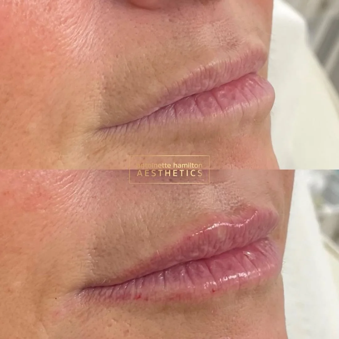 1ml Belotero Lips 

For this patient, we used 1ml Belotero to create soft, natural-looking volume while maintaining movement and shape.

Belotero is a great option for lips when the goal is:
&bull;⁠ ⁠Subtle enhancement
&bull;⁠ ⁠Smooth integration int