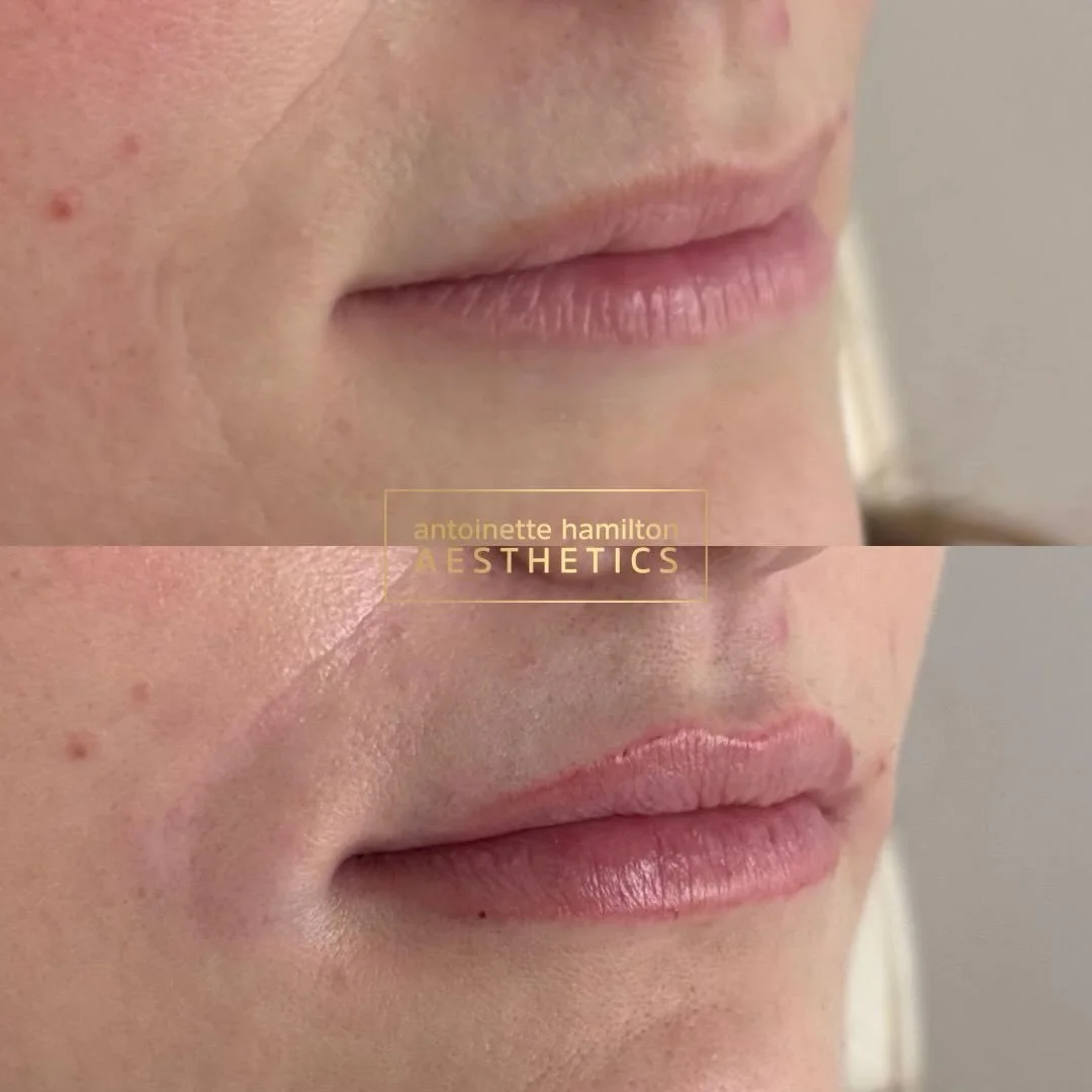 Subtle, balanced enhancement for this patient

Treatment included:
&bull; 1ml Stylage lips &ndash; &pound;270
&bull; 1ml nasolabial folds &ndash; &pound;250

A combination approach to soften lines and restore structure while keeping everything natura
