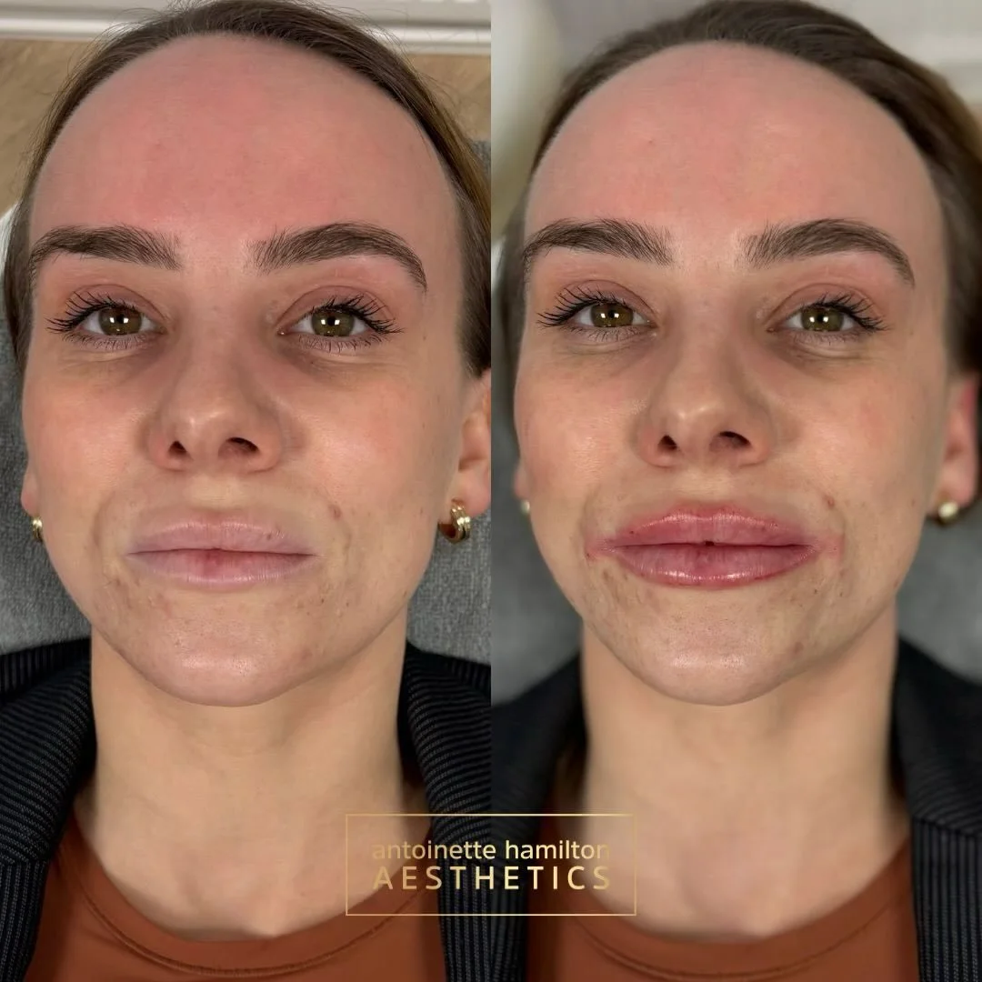 Cheeks &amp; lips combination 
&bull; 1ml cheeks &ndash; &pound;310
&bull; Lips &ndash; &pound;260

Subtle structure, soft volume and balanced results.

Book a consultation to discuss what&rsquo;s right for you 📩
