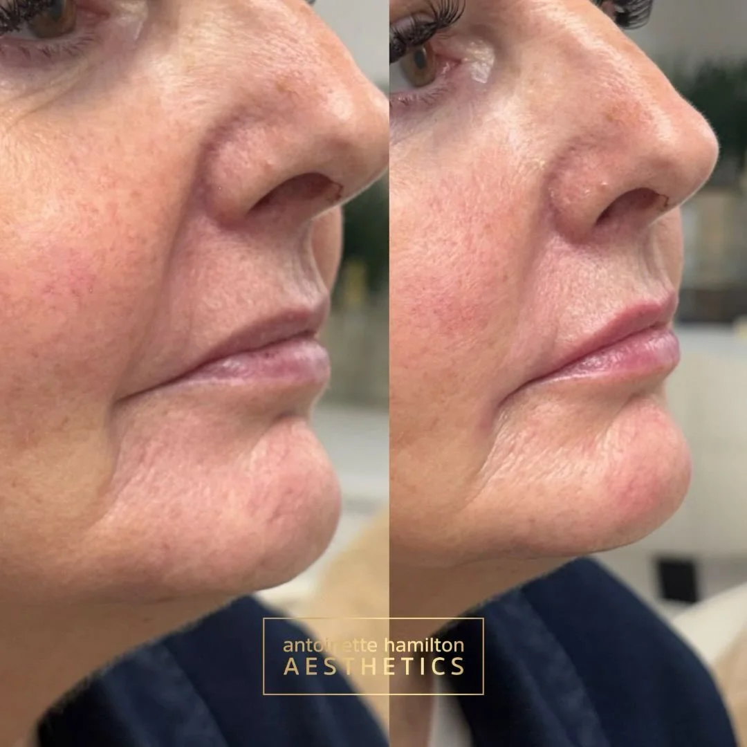 Lower facial folds and lips treated using 2ml in total, carefully placed to restore balance and soften the overall appearance.

A bespoke approach allows for subtle enhancement while maintaining natural movement and structure.

&pound;450 for 2ml.

B