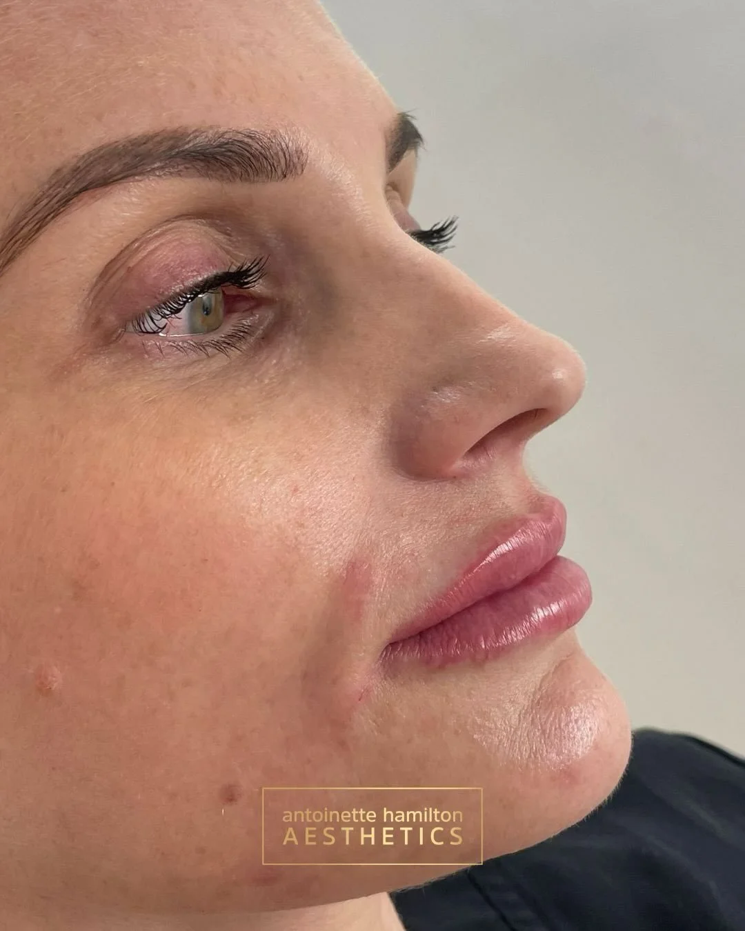 Here are Gemma&rsquo;s gorgeous results from the video I posted the other day!

Soft, balanced definition with a natural finish.

1ml lip enhancement
&pound;260

Book your consultation today via the link in my bio