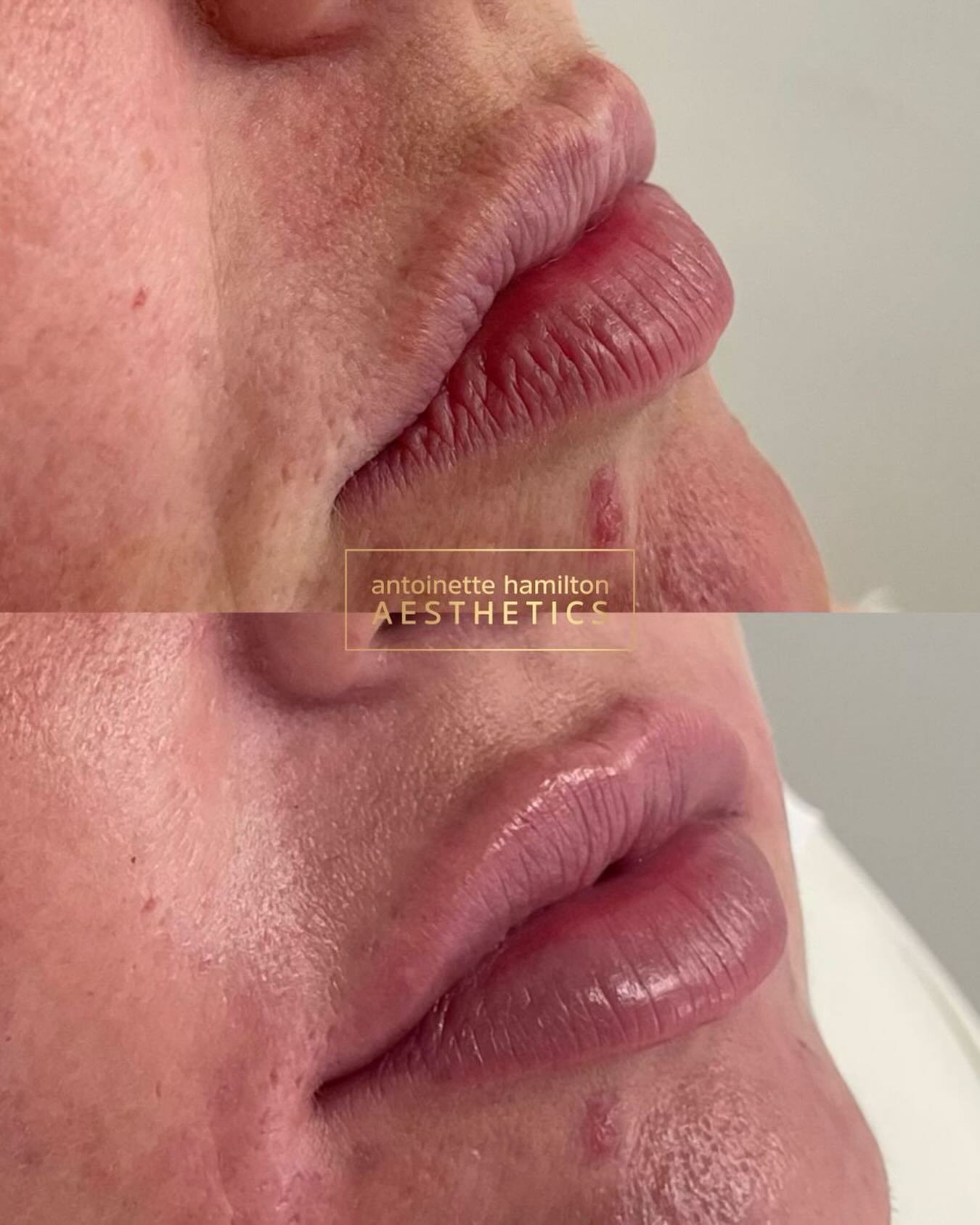 1ml lip enhancement 

Designed to enhance shape, balance, and definition while maintaining a soft, natural result.

&pound;260
📍 Bury, Manchester