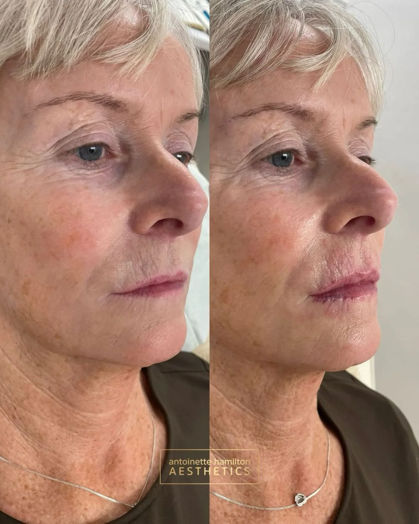 1ml balance treatment between the lips and perioral area.

Designed to soften fine lines around the mouth while restoring subtle structure and harmony to the lips.

1ml filler, &pound;290

A balanced approach often creates the most natural overall re