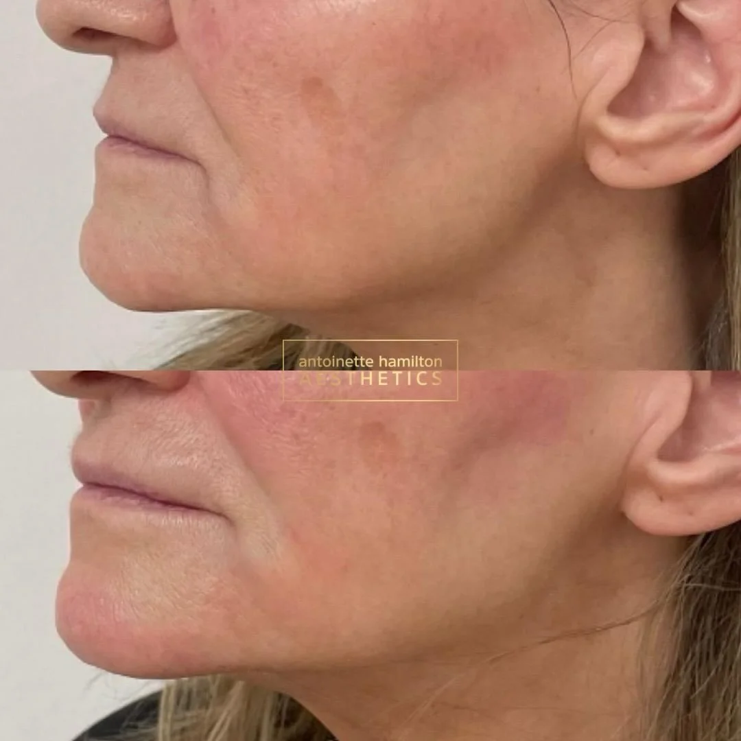 1.5ml lower face rejuvenation &pound;400

Collagen Stimulation using Radiesse - immediately after treatment you will see results, followed by continued results over the next few months as the collagen gets stimulated.

Book your consultation via the 