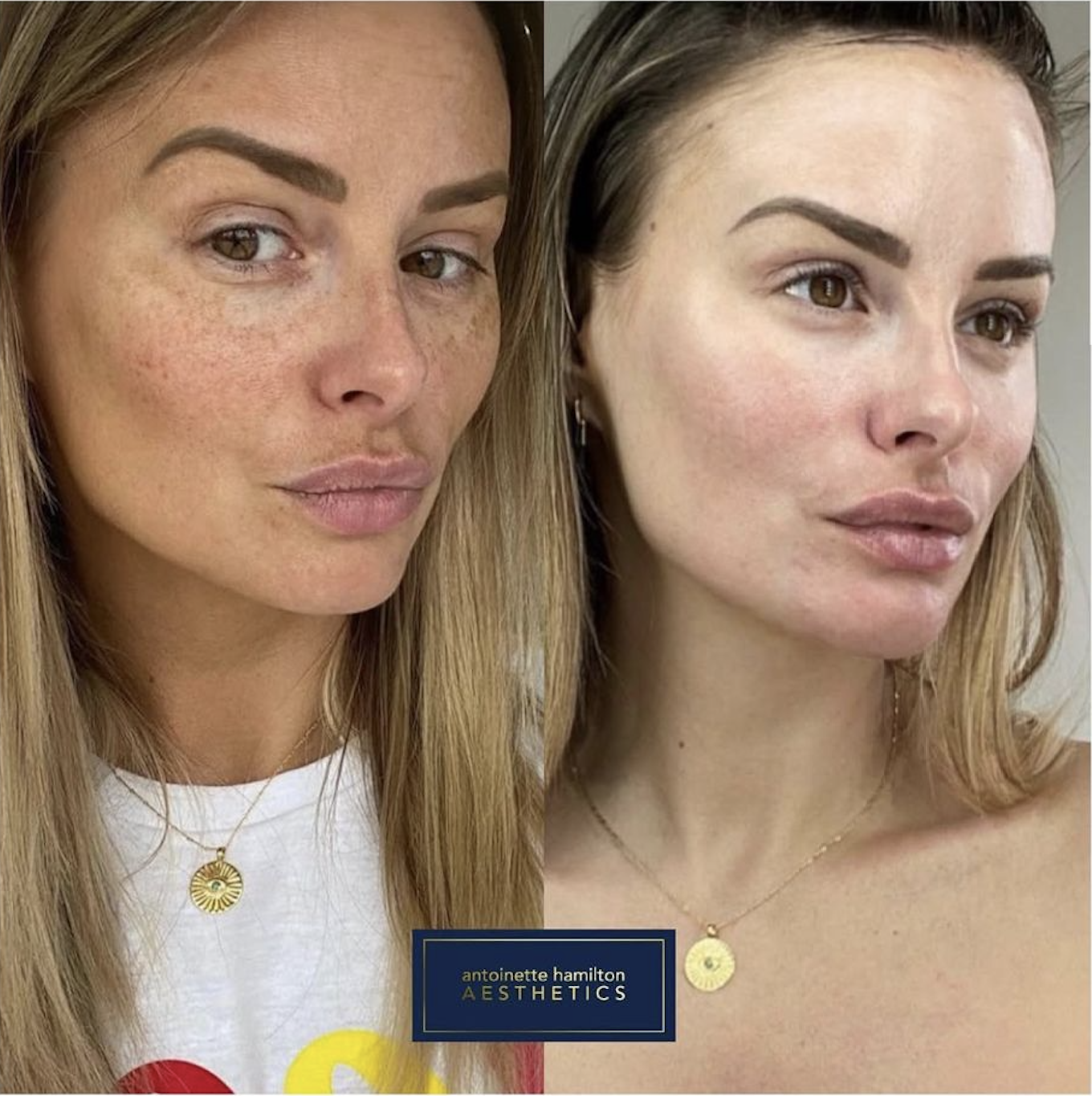 Why Hyperpigmentation Gets Worse in Warmer Months (and how to manage it properly)