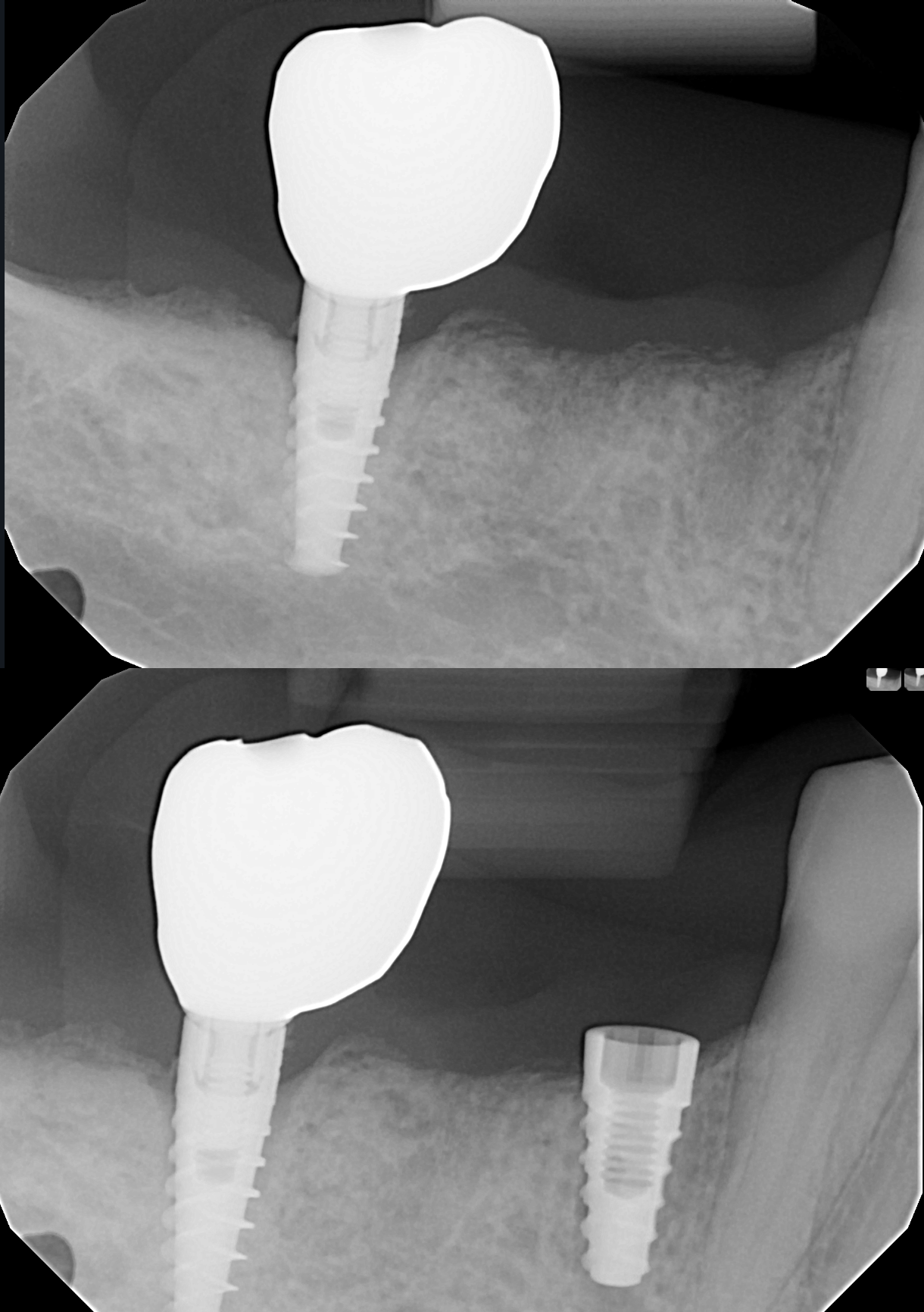 ersättning för tänder
