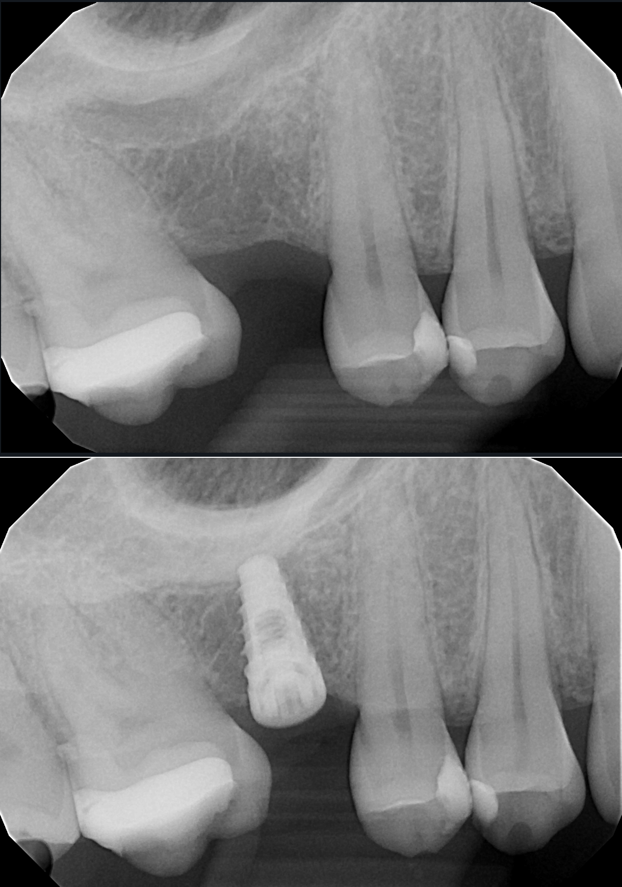 tandlös ett implantat