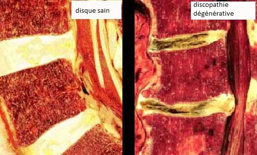 Mal de dos, douleur lombaire, il s'agit peut être une discopathie dégénérative. Une colonne saine sans douleur et une colonne avec des discopathie et des douleurs