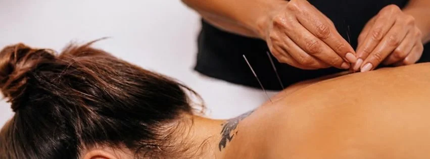 Acupuncture needles being placed along the back