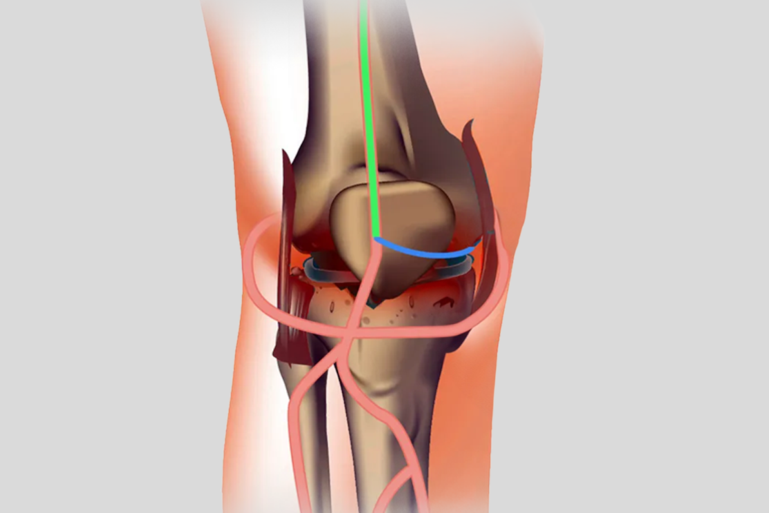 Geniculate Artery Embolization: What It Is, How It Works, and Who Should Learn More