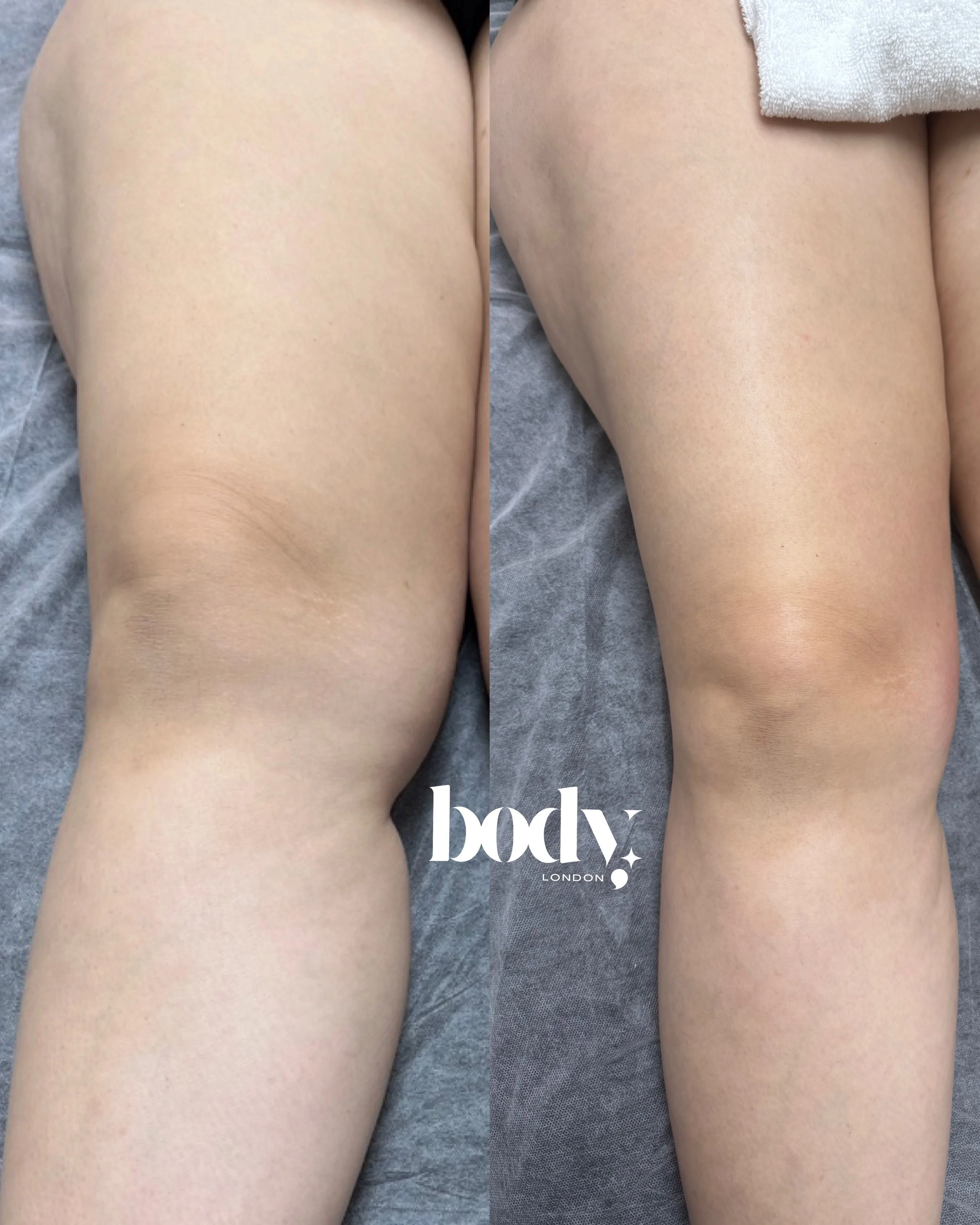 Side-by-side comparison of a person's thighs before and after skin treatment, showing smoother and more even skin tone on the right.