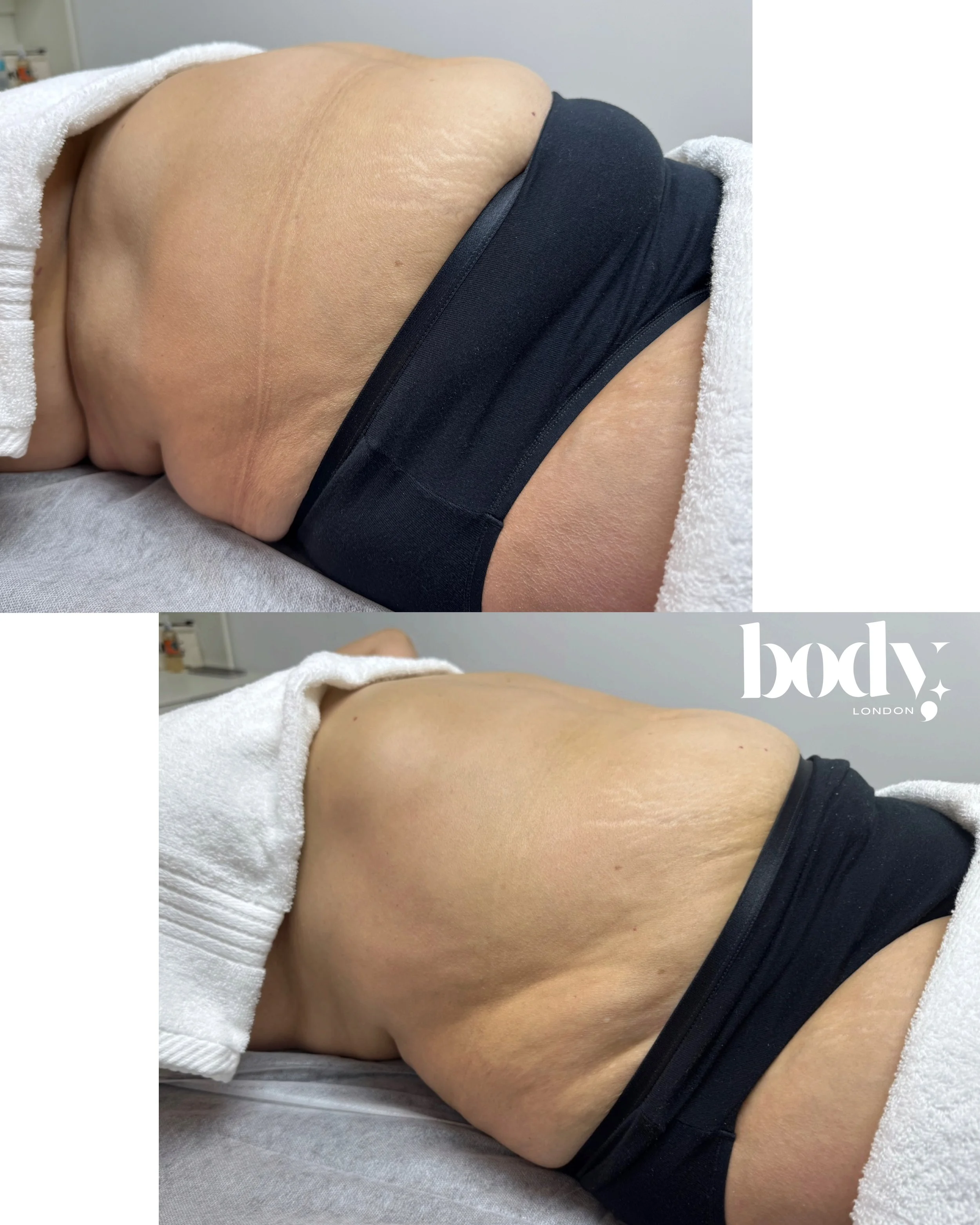 Close-up of a person's side torso and back, lying on a treatment table, showing skin texture and stretch marks. The person is wearing a black garment and a white towel is draped over their shoulder. There is a logo that reads 'body London' in the cor