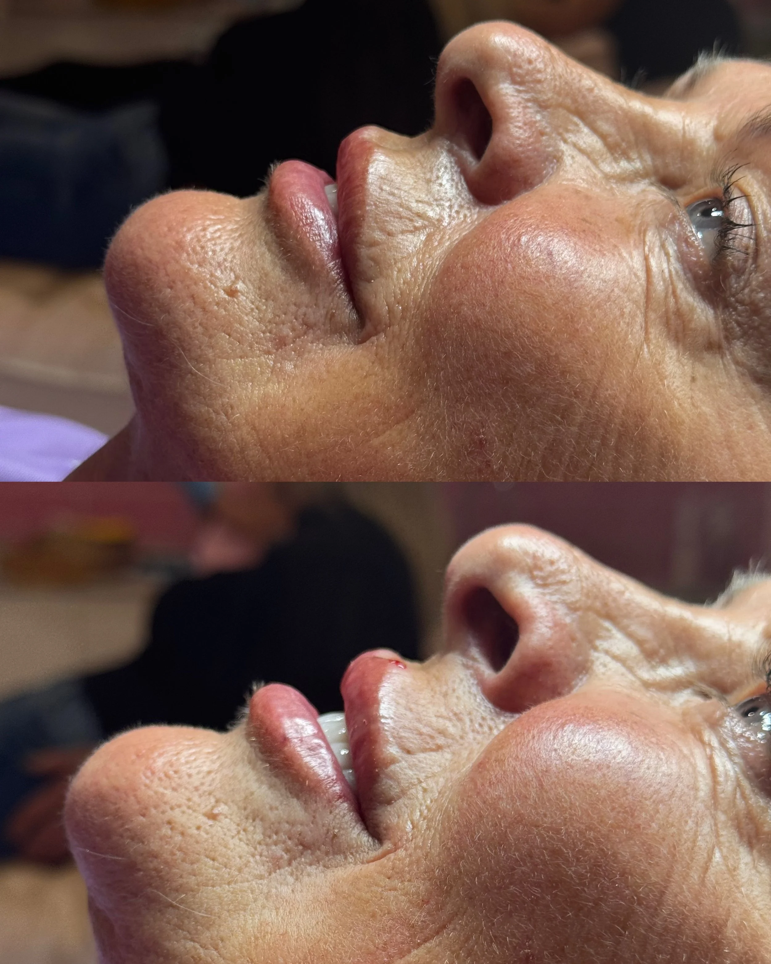 Close-up of a woman's face from the side, showing before and after skin treatment, with visible improvement in skin texture and clarity.