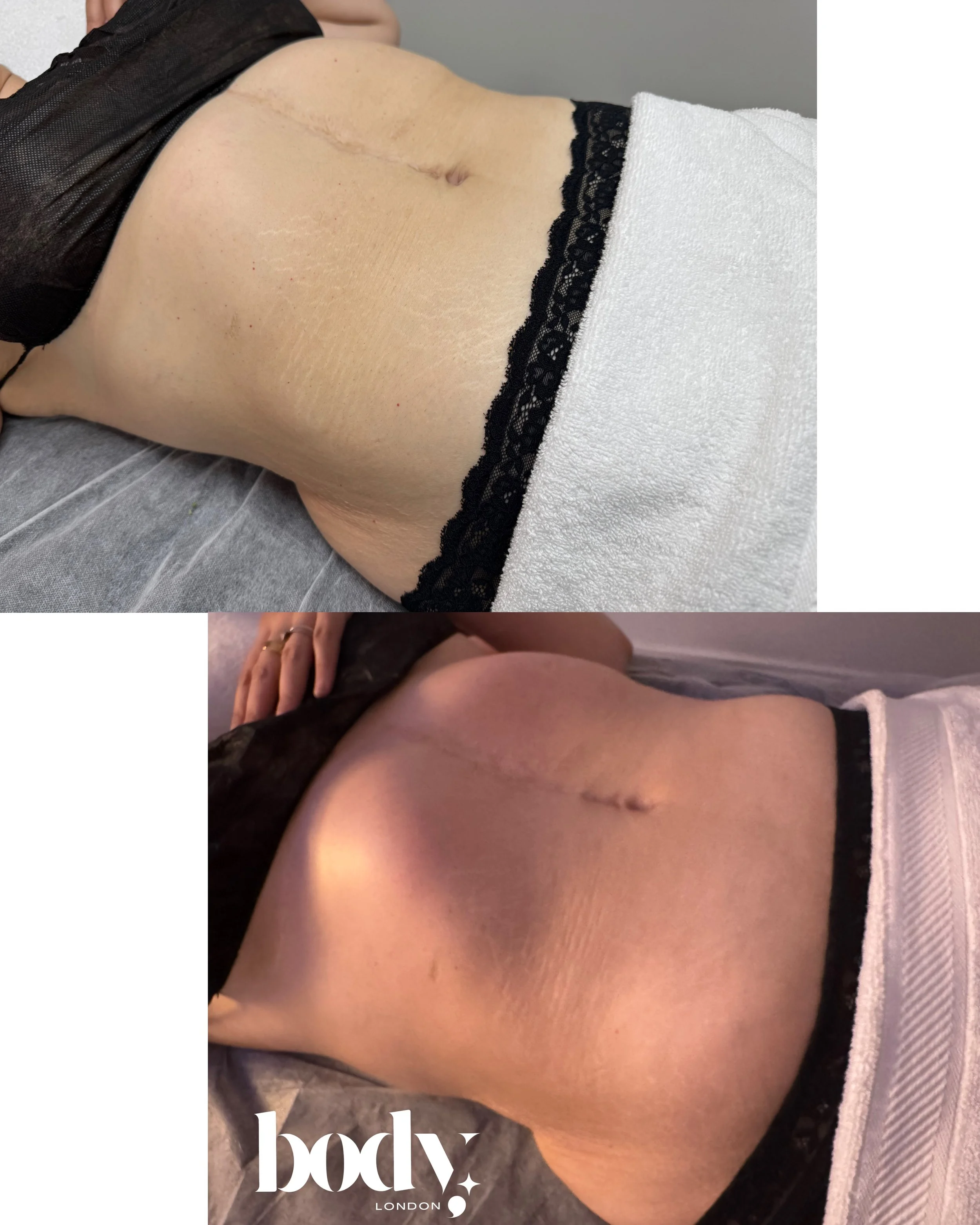 Two photos of a person's lower back and buttocks, showing a fresh surgical scar. The person is lying face down on a surface, wearing underwear with lace trim. The top photo shows the scar from a different angle without text, and the bottom photo has 
