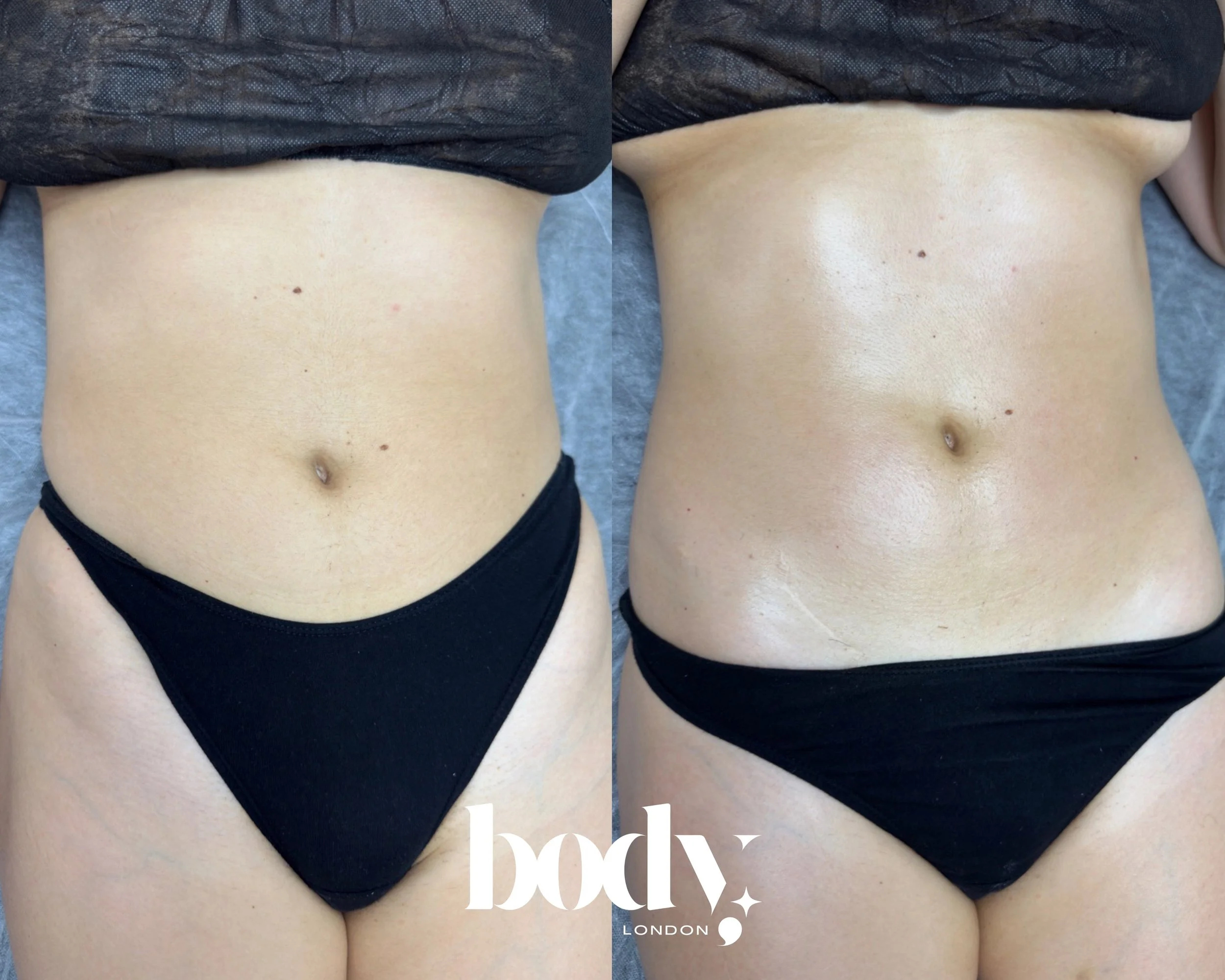 Comparison photo showing a person's abdomen before and after a body contouring treatment, with the 'Body London' logo at the bottom.
