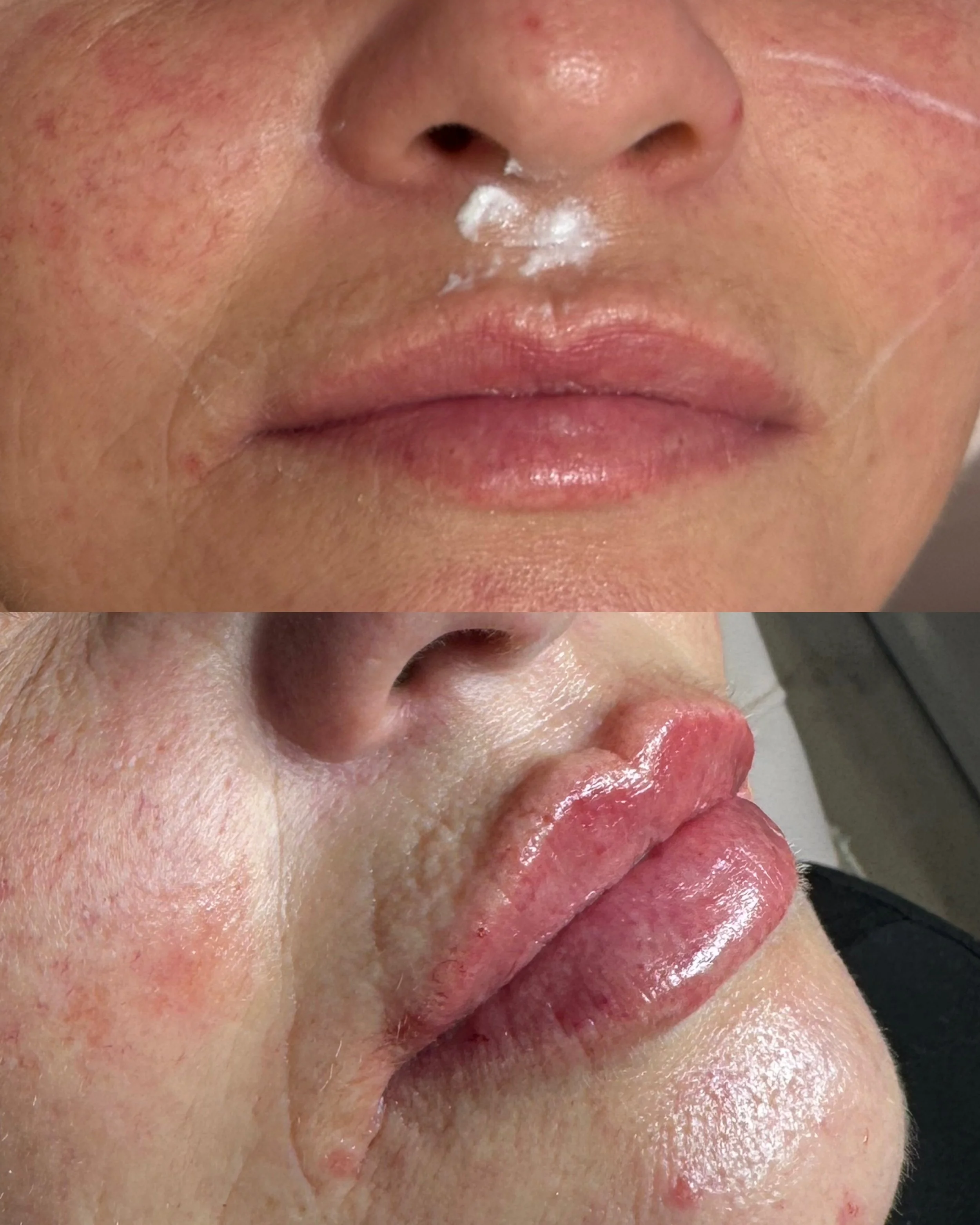 Close-up of a person's face before and after lip augmentation, showing the lips with improved volume and shape, and some residual cream or ointment on the nose.