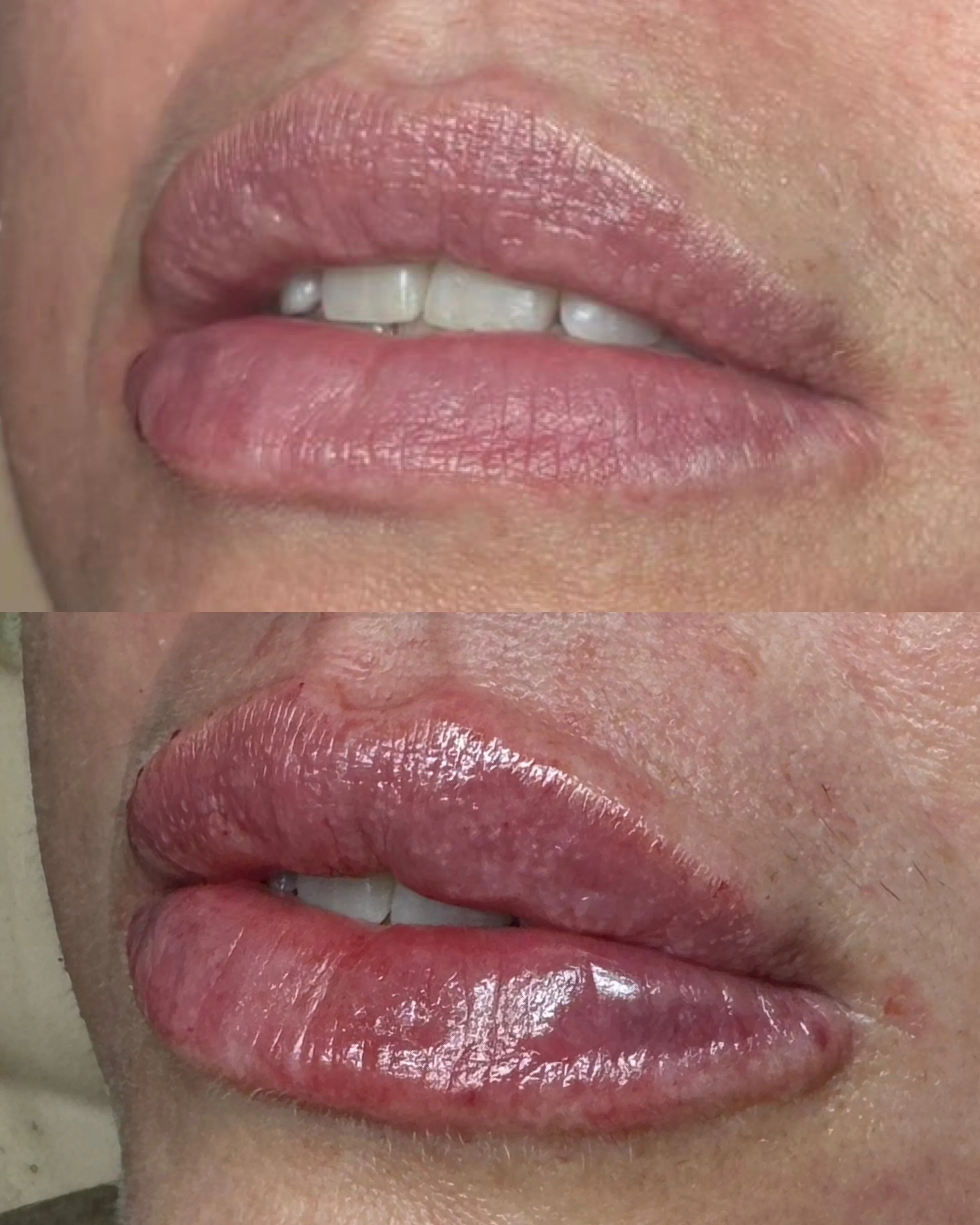 Close-up of lips before and after cosmetic lip enhancement. The top image shows natural lips, while the bottom image shows enhanced, plumper, and glossier lips.