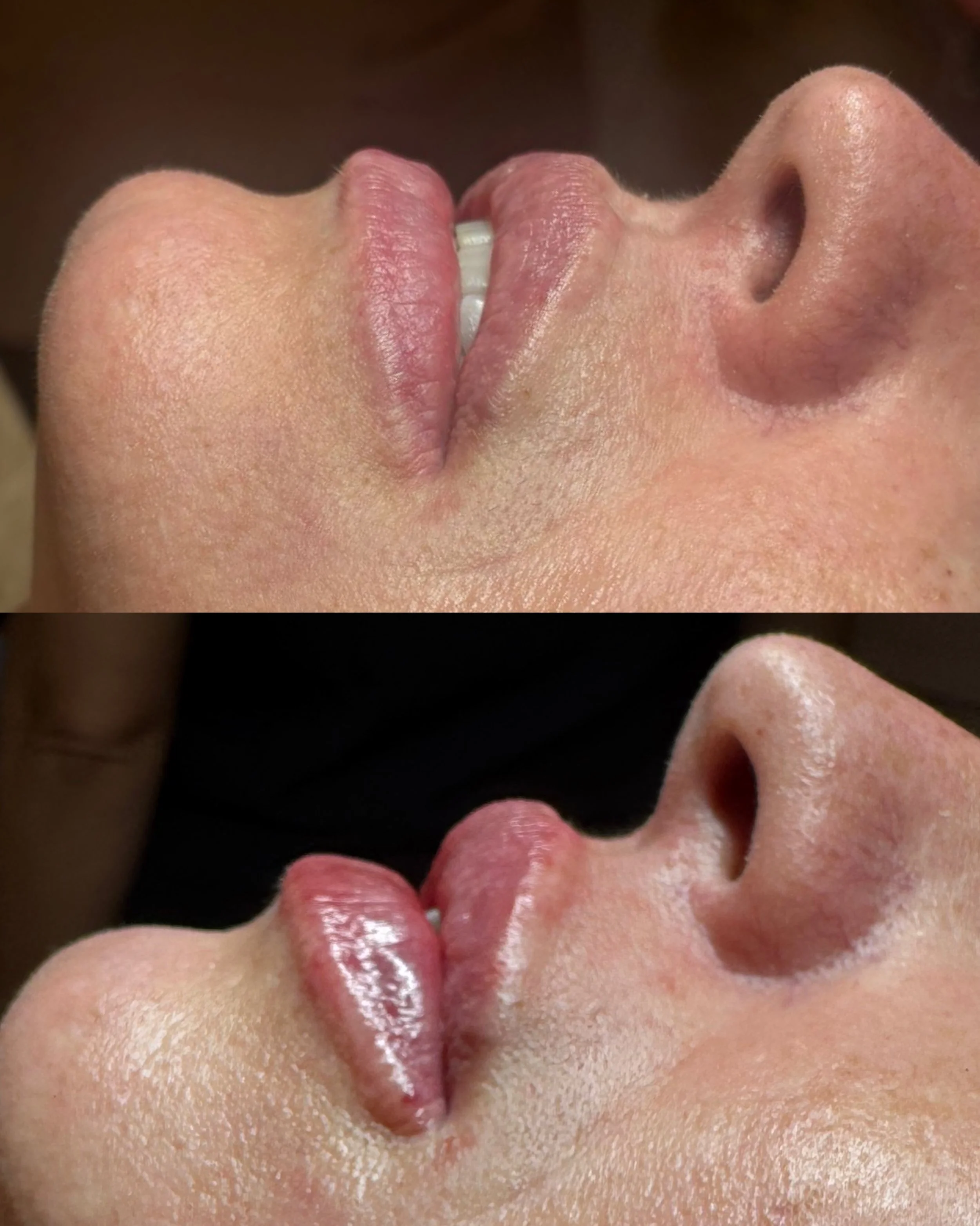 A close-up before and after comparison of lips and nose of a person, showing the lips partially opened and a natural skin texture.