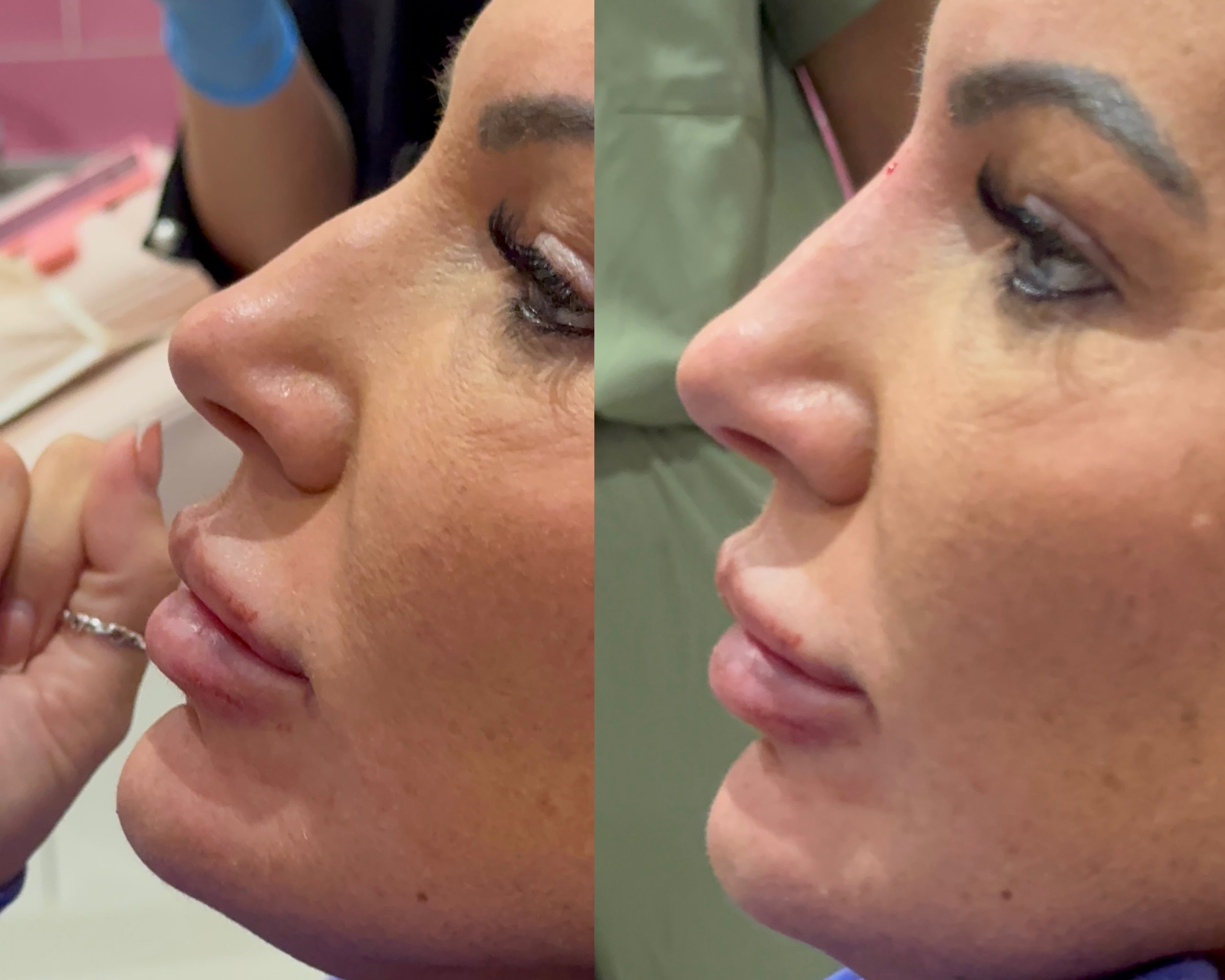 Side-by-side comparison of a woman's face showing before and after a non surgical rhinoplasty cosmetic procedure, focusing on the nose and cheek area.