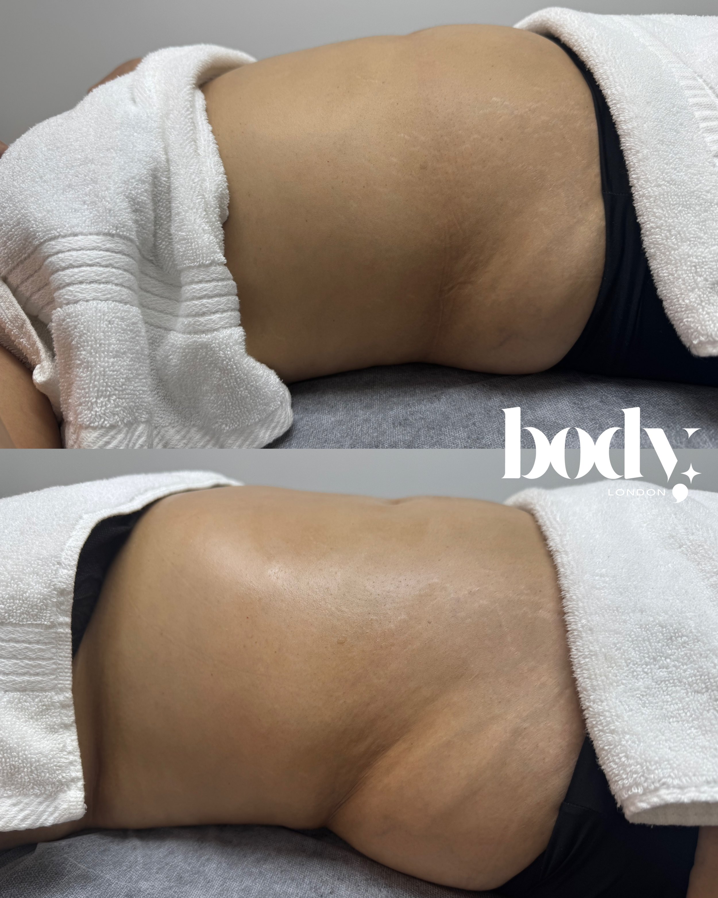 Comparison of a person's hip and waist area before and after a cosmetic body contouring treatment. The top shows the hips with some skin imperfections, and the bottom shows a smoother, more toned appearance.