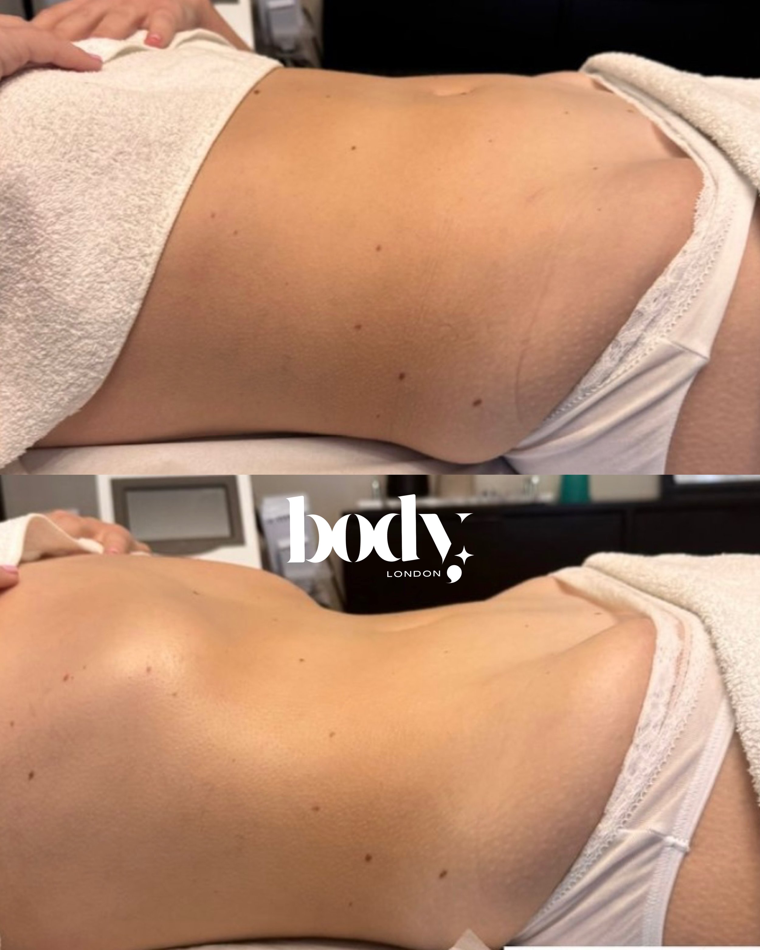 Side-by-side comparison of a person's back showing before and after skin treatment, with visible smoothing and brightening of skin.
