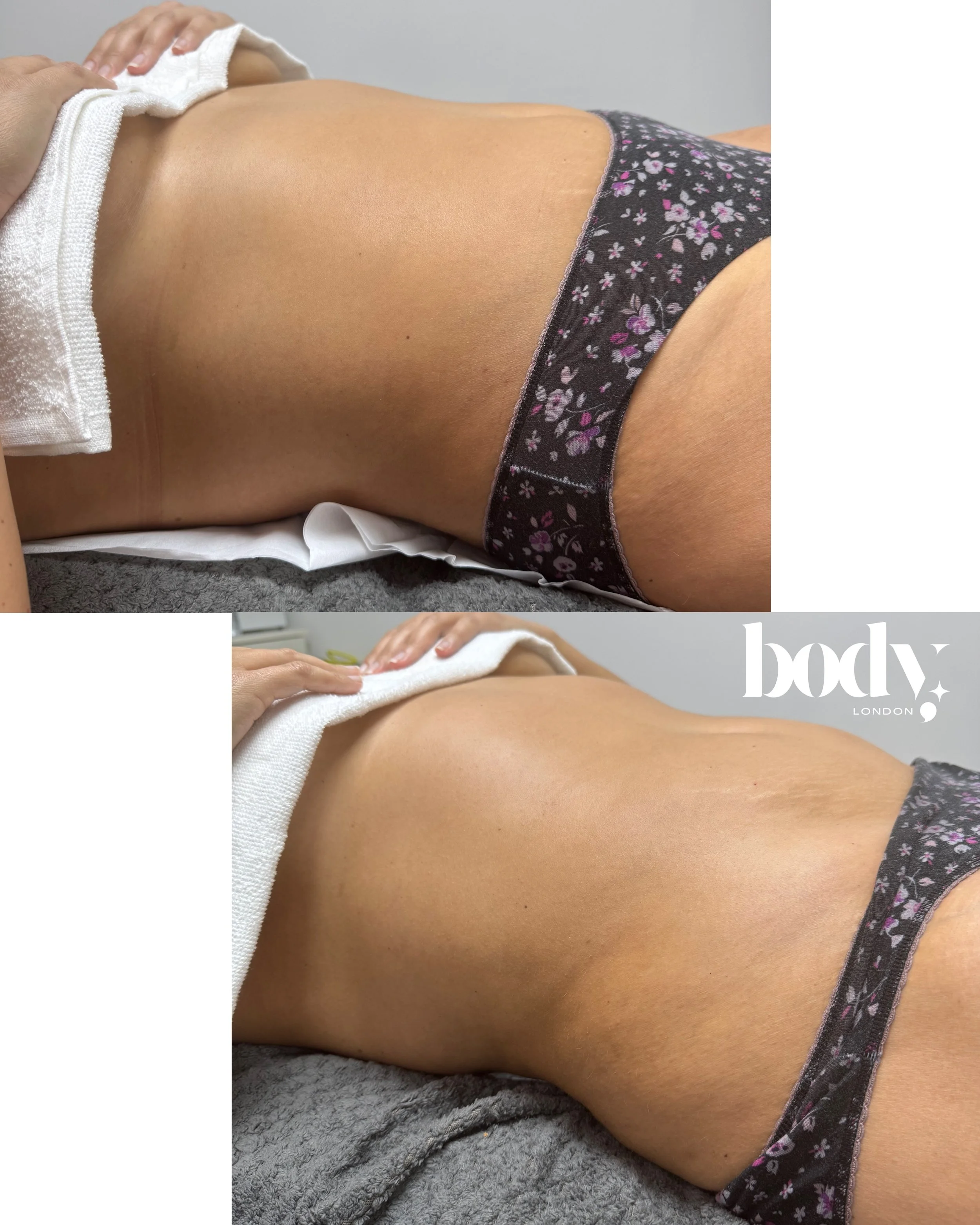 Comparison of a person's back before and after a massage or skincare treatment, showing smoother skin in the after photo.