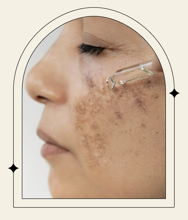 Healing Acne