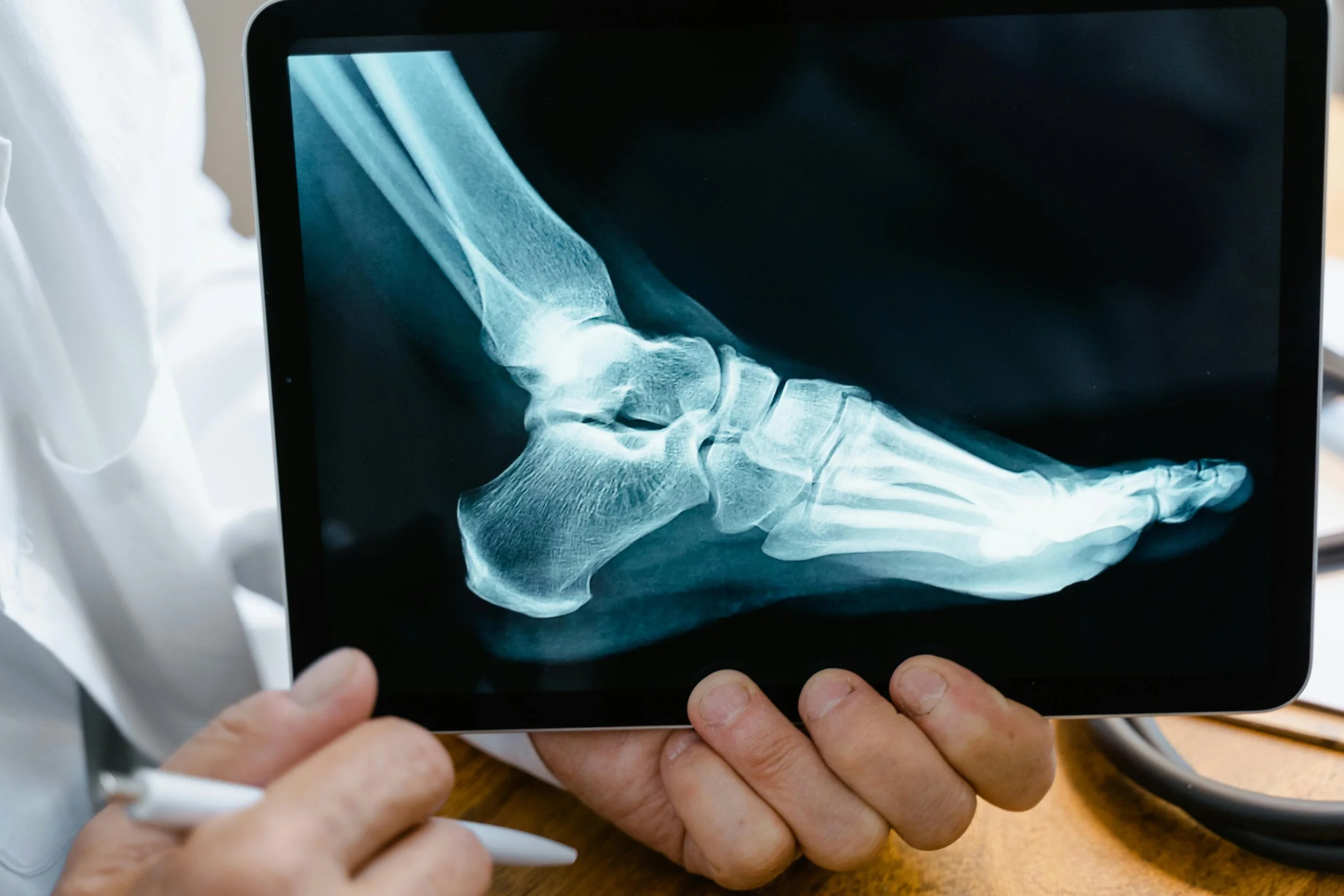 Can Chiropractic Help After a Serious Injury or Broken Bones? What Missoula Patients Should Know