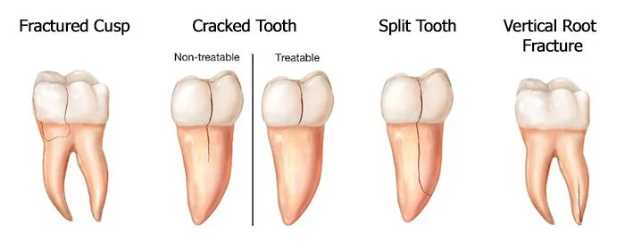 Not All Chips Are Emergencies: Tooth Cracks Explained by Your Delhi Dentist