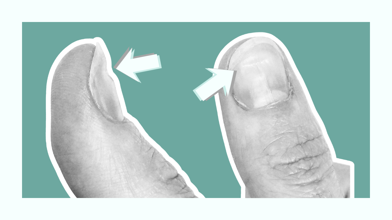 Nail ridges after press-on nails: causes, prevention &amp; nail care guide