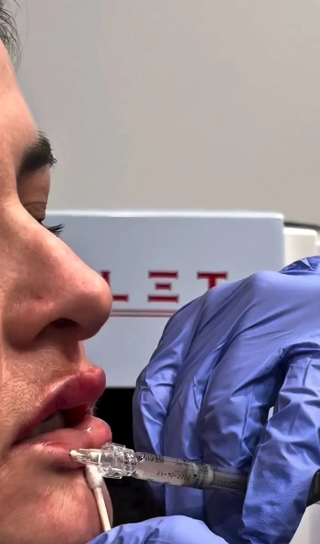 A natural-looking lip refresh can make a big difference when you want a little more balance and shape. At Younique by MK in Charlotte, North Carolina, we use fillers with a careful, detailed approach so results look smooth, not overdone. If you also 