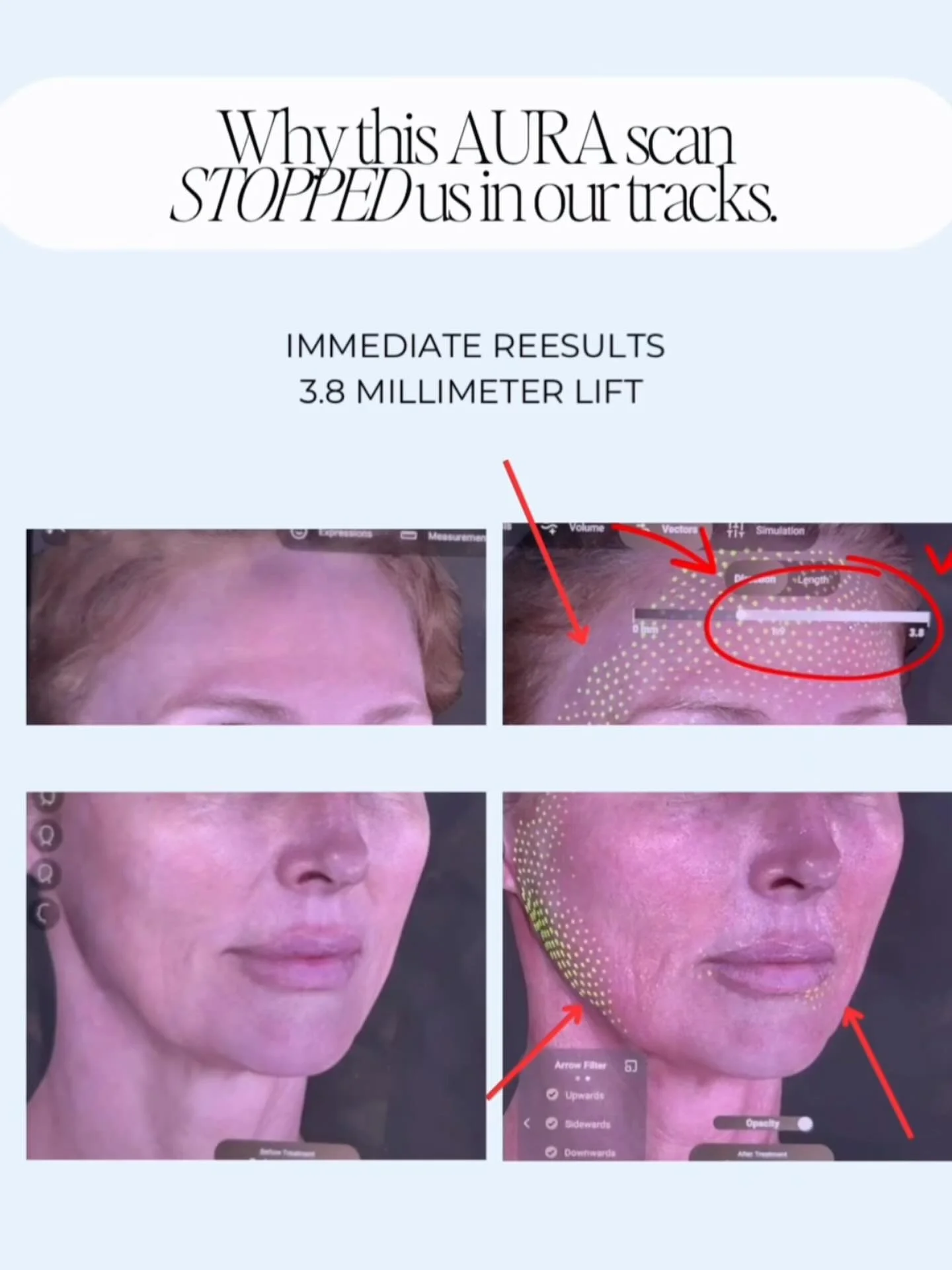 Something new just landed at Younique by MK Medspa in Charlotte, North Carolina. We now offer Aura reality, a new skin analysis machine that scans your skin and helps us spot issues like sun spots, uneven tone, and texture concerns, so your plan is b