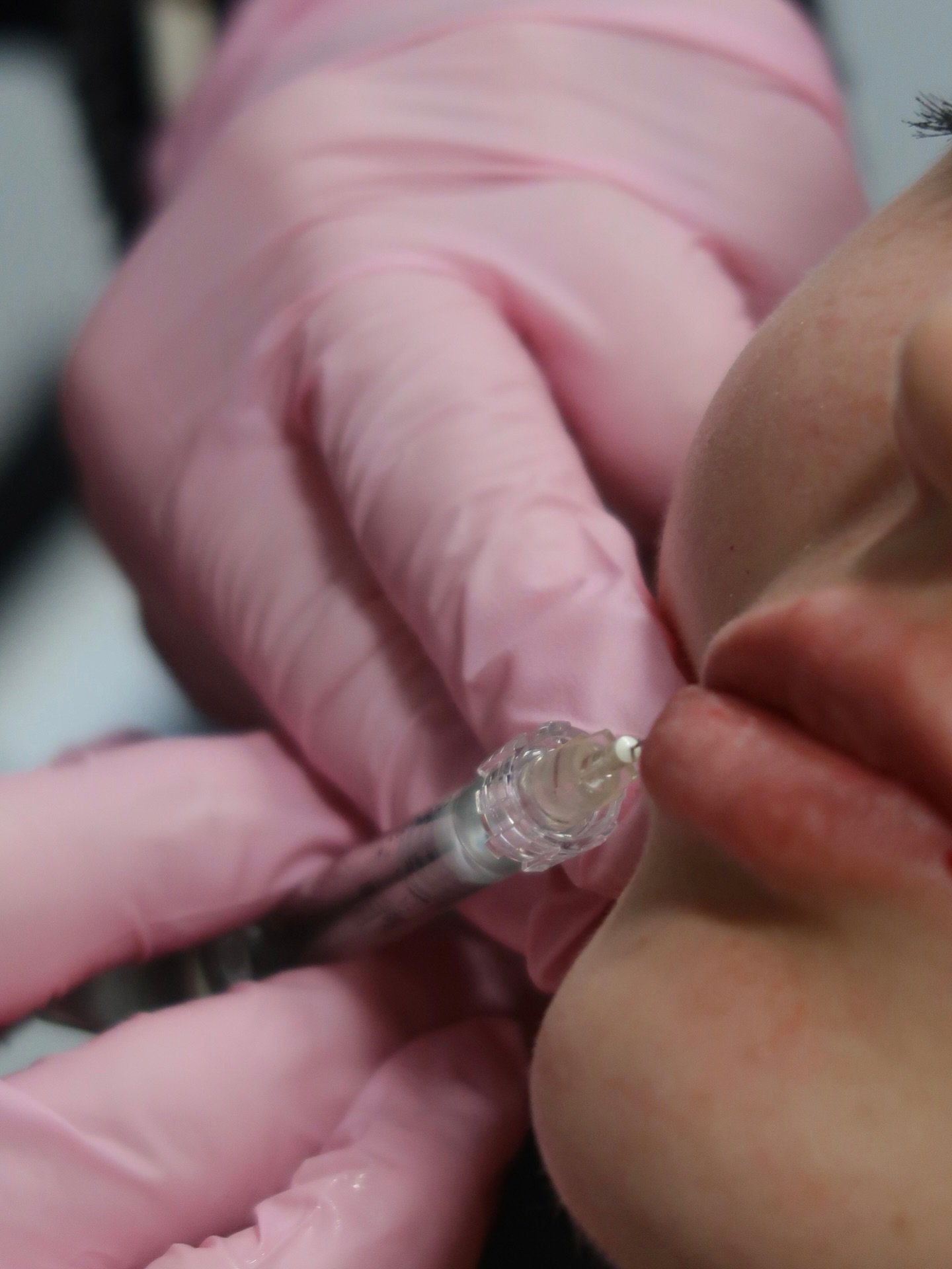 At Younique by MK, we help Charlotte clients soften lines with natural-looking botox results in a calm, professional setting. Your visit starts with a real conversation about what you want to change and what you want to keep. If you are also dealing 