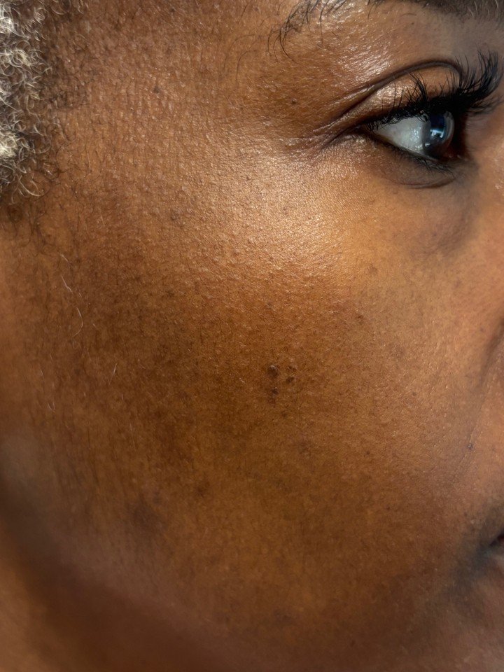 Uneven skin tone on the cheeks can come from sun spots, old breakouts, and texture changes over time. At Younique by MK in Charlotte, we focus on simple, personalized plans that help your skin look smoother and more even. Microneedling is a great opt