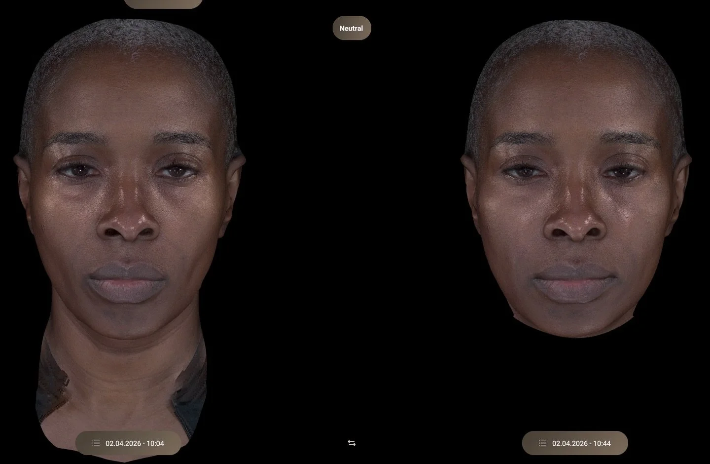 Witness the incredible results of our cheek filler and midface bio stimulator treatment, restoring volume loss beautifully. Check out the before and after images analyzed with our Aura Face Analyzer!

-

#medspa #cltmedspa #charlotteaesthetics #cheek
