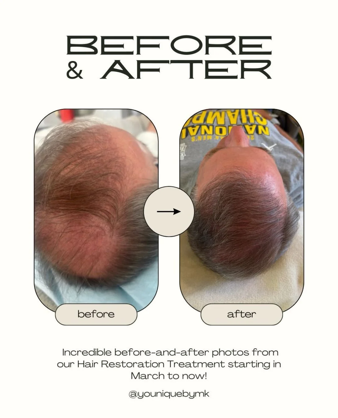 Transformation isn&rsquo;t just about change; it&rsquo;s about regaining confidence. This before &amp; after shows the incredible impact of our latest Hair Restoration Treatment. More density, more coverage, and real results. ✨

Book your consult wit