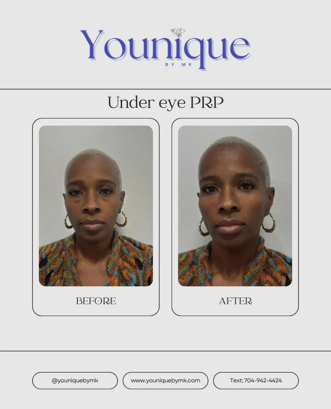 ✨Bright eyes, refreshed look. 
Take a look at these results from our Under-Eye PRP Treatment 

PRP uses components from your own blood to support the skin&rsquo;s natural rejuvenation process, making it a popular option for those looking to improve t