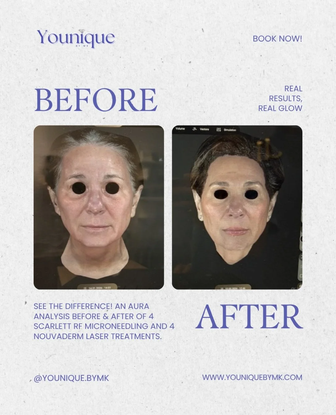 Real results, captured beyond what the eye can see. ✨

This before &amp; after was captured using our Aura 3D Skin Analysis following a series of 4 Scarlett RF Microneedling treatments + 4 NouvaDerm Laser treatments. 🤍

A personalized treatment plan