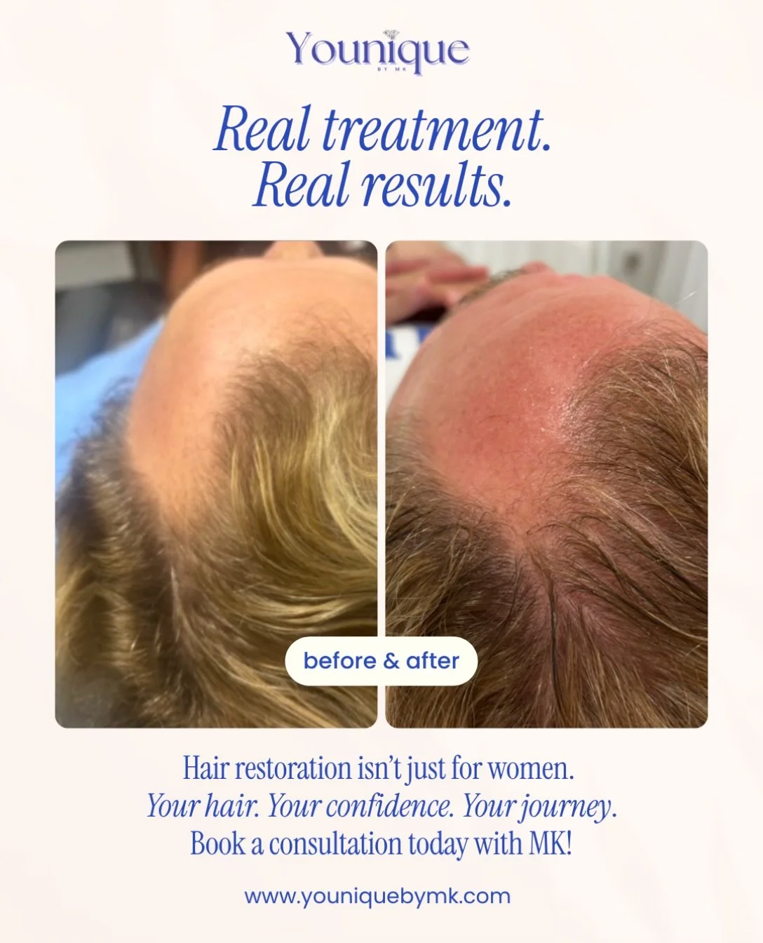 Gentlemen, this one&rsquo;s for you! 👀💙 Hair restoration isn&rsquo;t just for women, and these before-and-after results speak for themselves! 🌱✨

Hair thinning, receding hairlines, and hair loss can affect men just as much as women, and there&rsqu