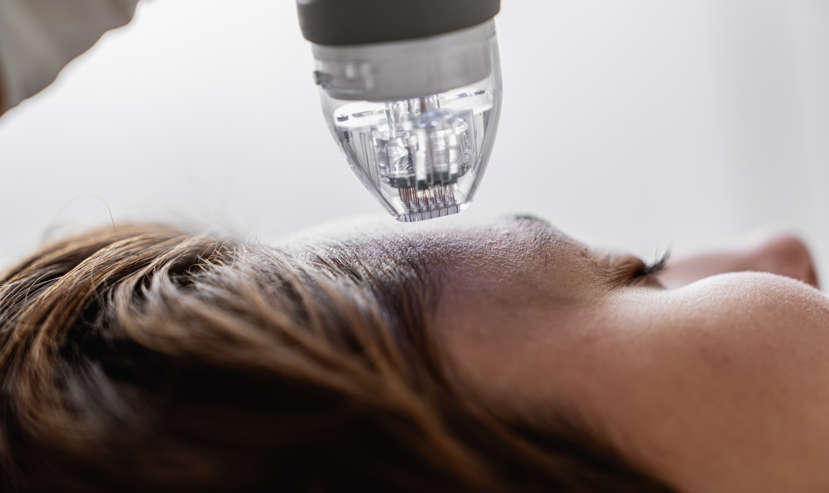 Microneedling and Scarlet RF in Charlotte
