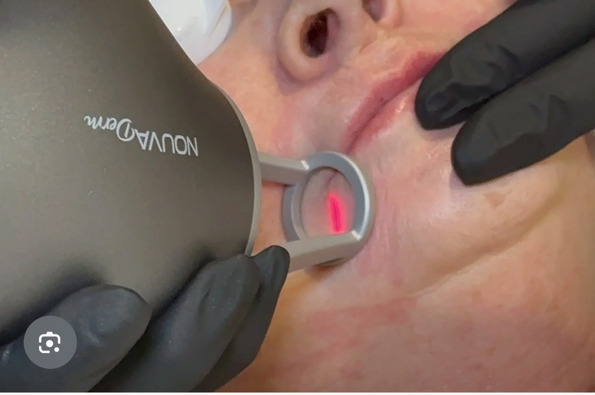 Nouvaderm Resurfacing Laser
